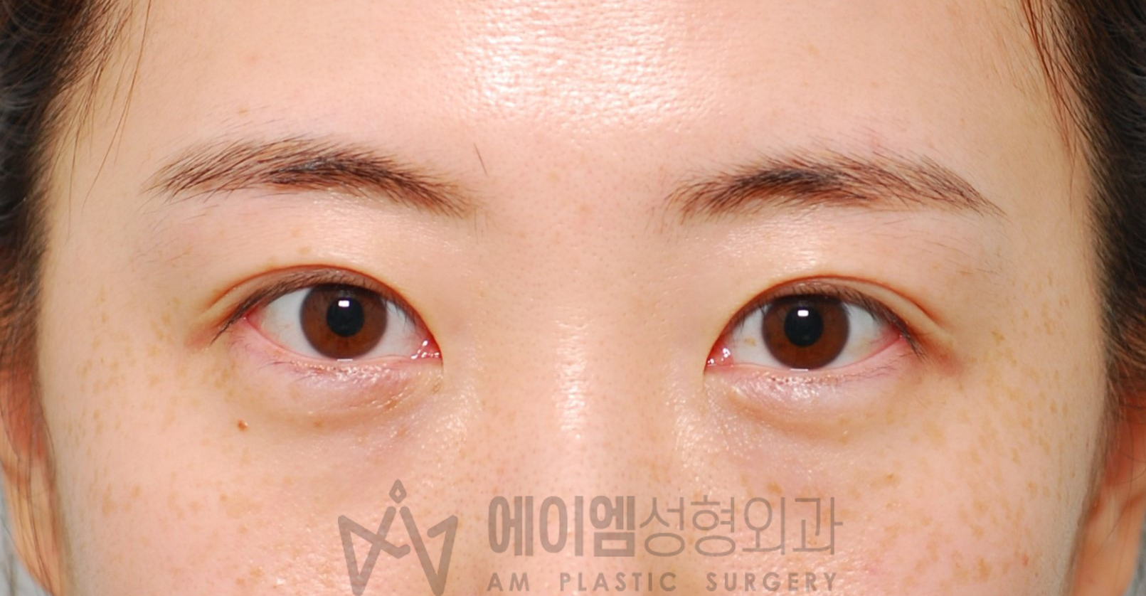 쌍꺼풀 풀림 절개법 교정 재수술 후 4년