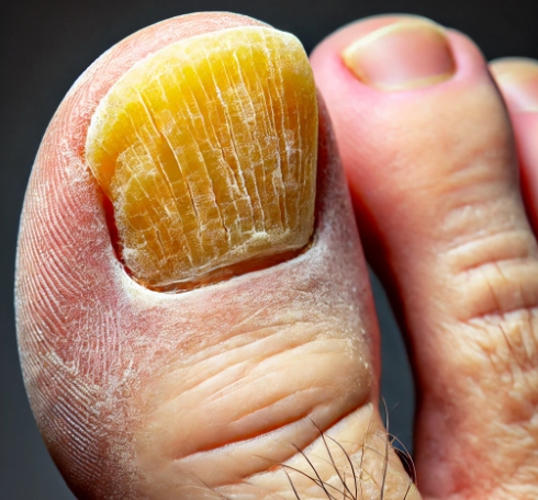 두꺼워지고 변색된 발톱