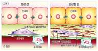 간경병