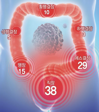 대장암 초기증상 1