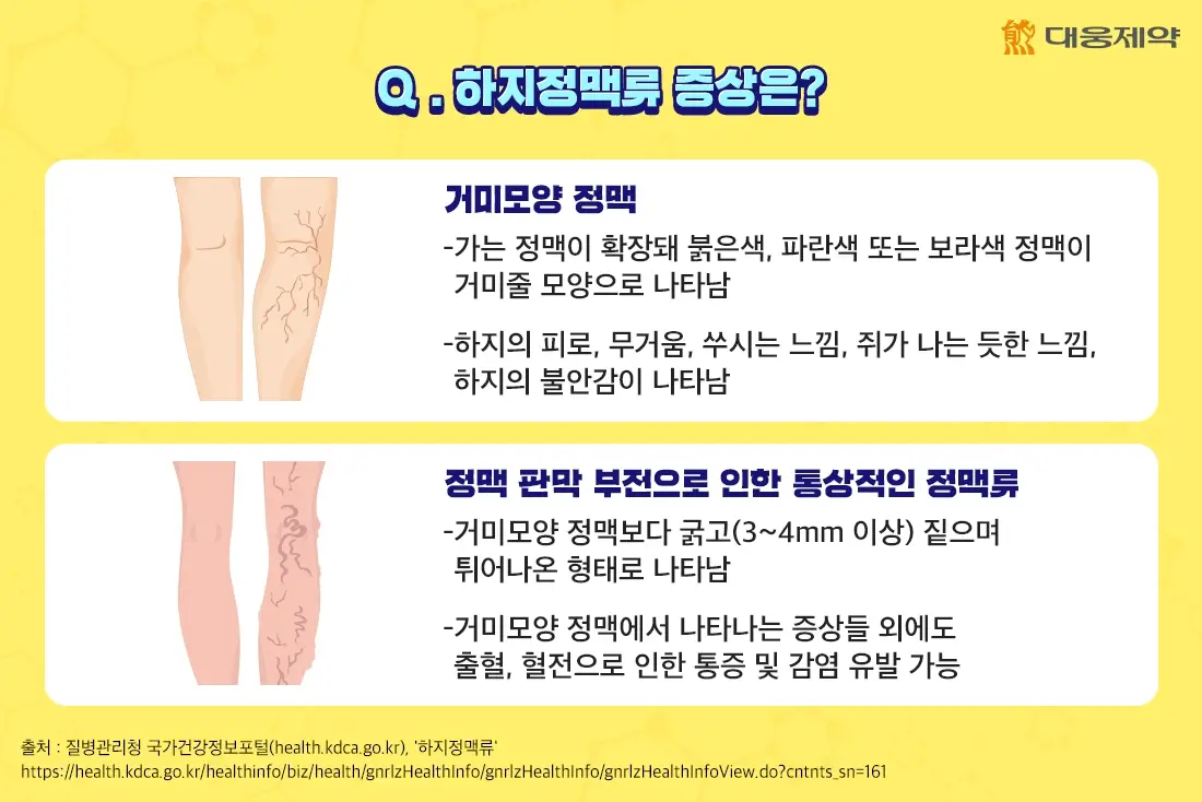출처-대웅제약,하지정맥류 증상