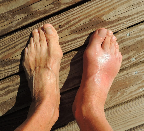 통풍 환자 발 모습