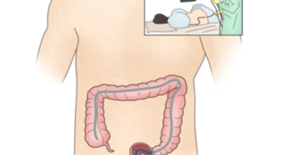 대장내시경이미지