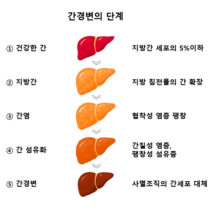 간경변의 단계