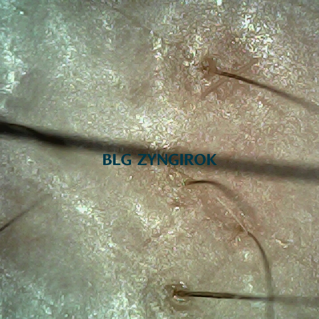 피나모아 복용 21주차 - 오른쪽 M자 부위 두피 모습이다.