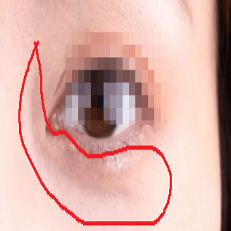 눈밑지방재배치 수술 전 사진 예시