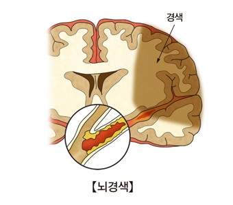 뇌경색 이미지