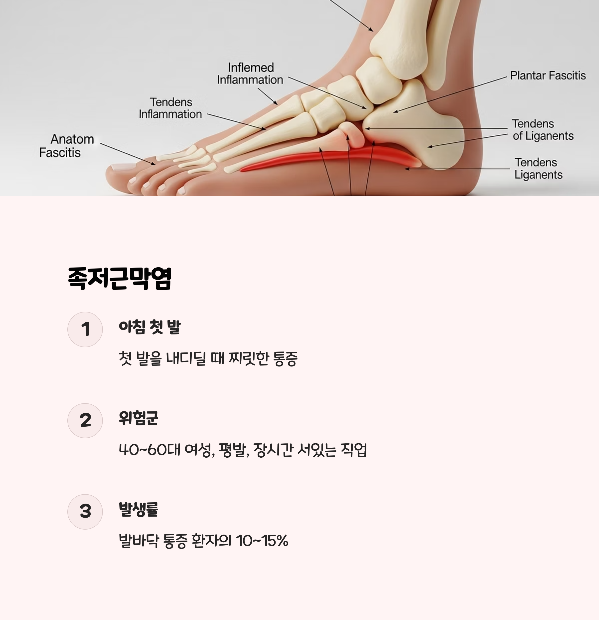 1.2 족저근막염: 아침 첫 발의 고통 👣