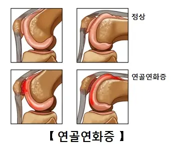 무릎통증원인&amp;#44; 나도 설마?