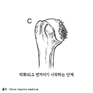 어깨통증원인