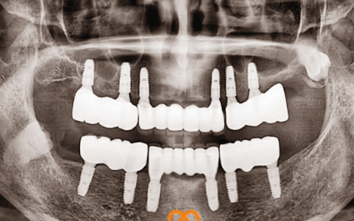 안산 임플란트 잘하는 치과