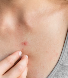 피부암 초기증상 18