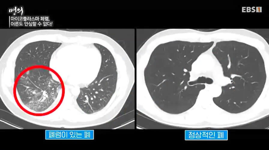 폐 사진