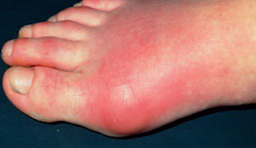 통풍 증상과 치료방법