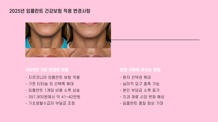 2025년 임플란트 건강보험 적용 기준 &ndash; 비용 절감할 수 있는 방법 총정리!