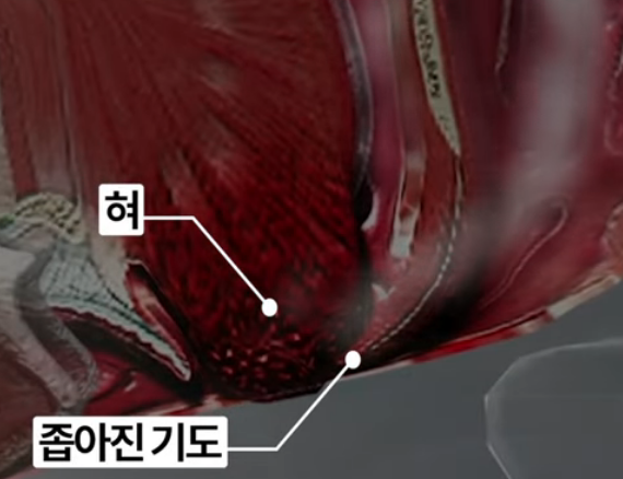 코골이의 원인 혀 근육 떨어지는 문제