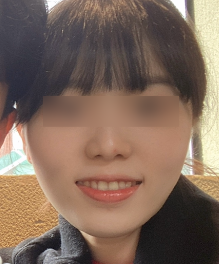 팔자 보톡스 후기