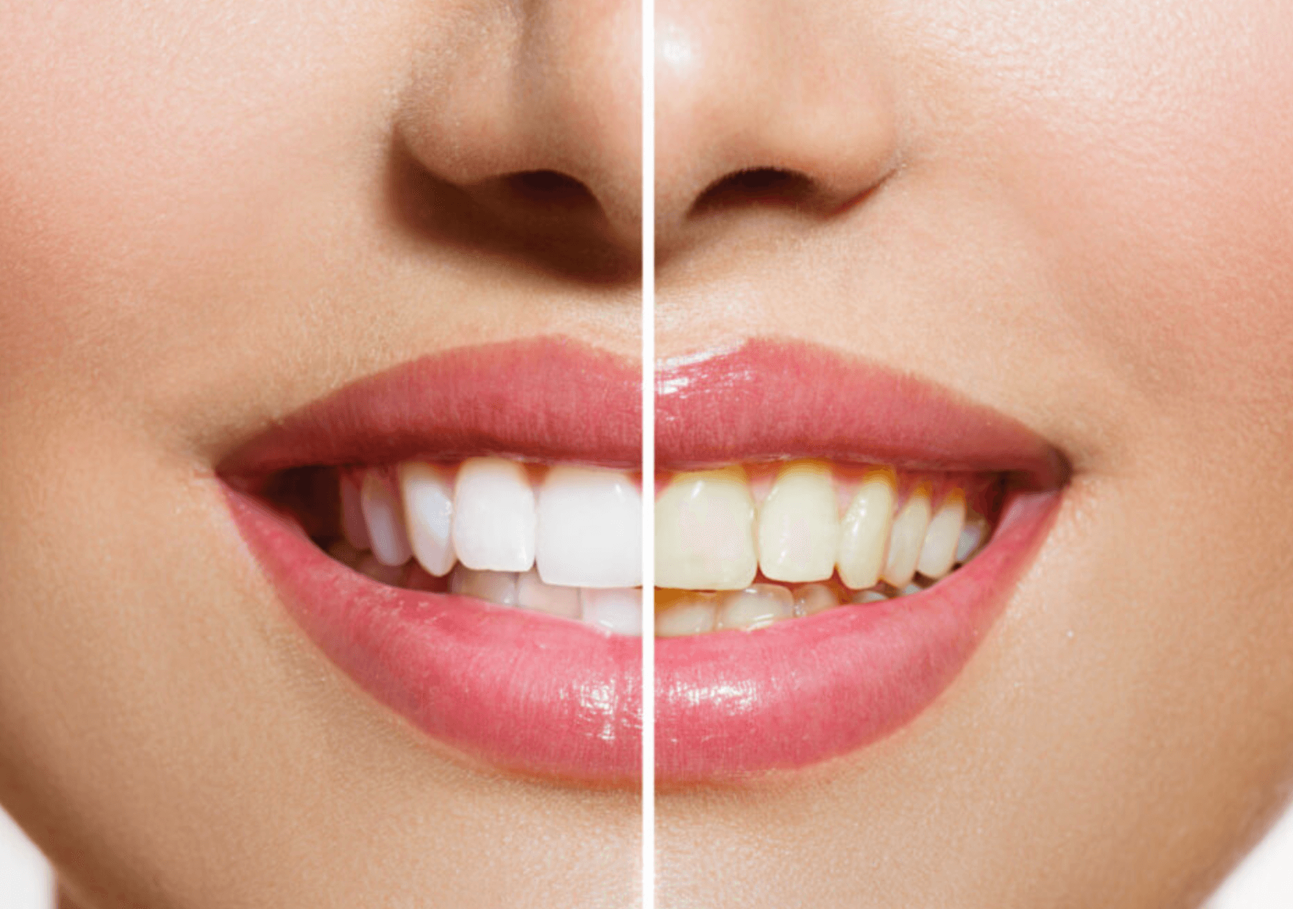 치아 변색 치료