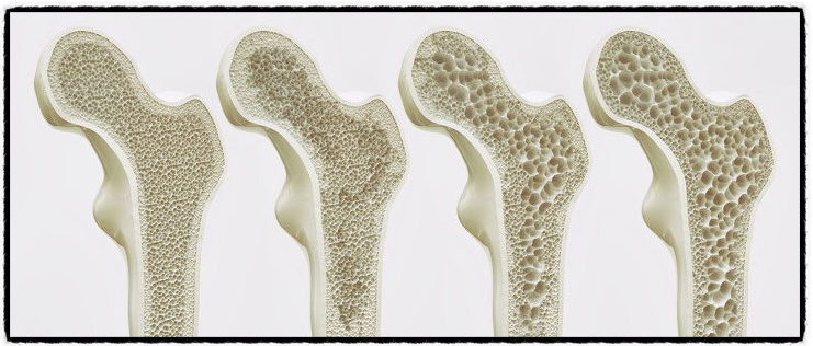골다공증 환자 사진