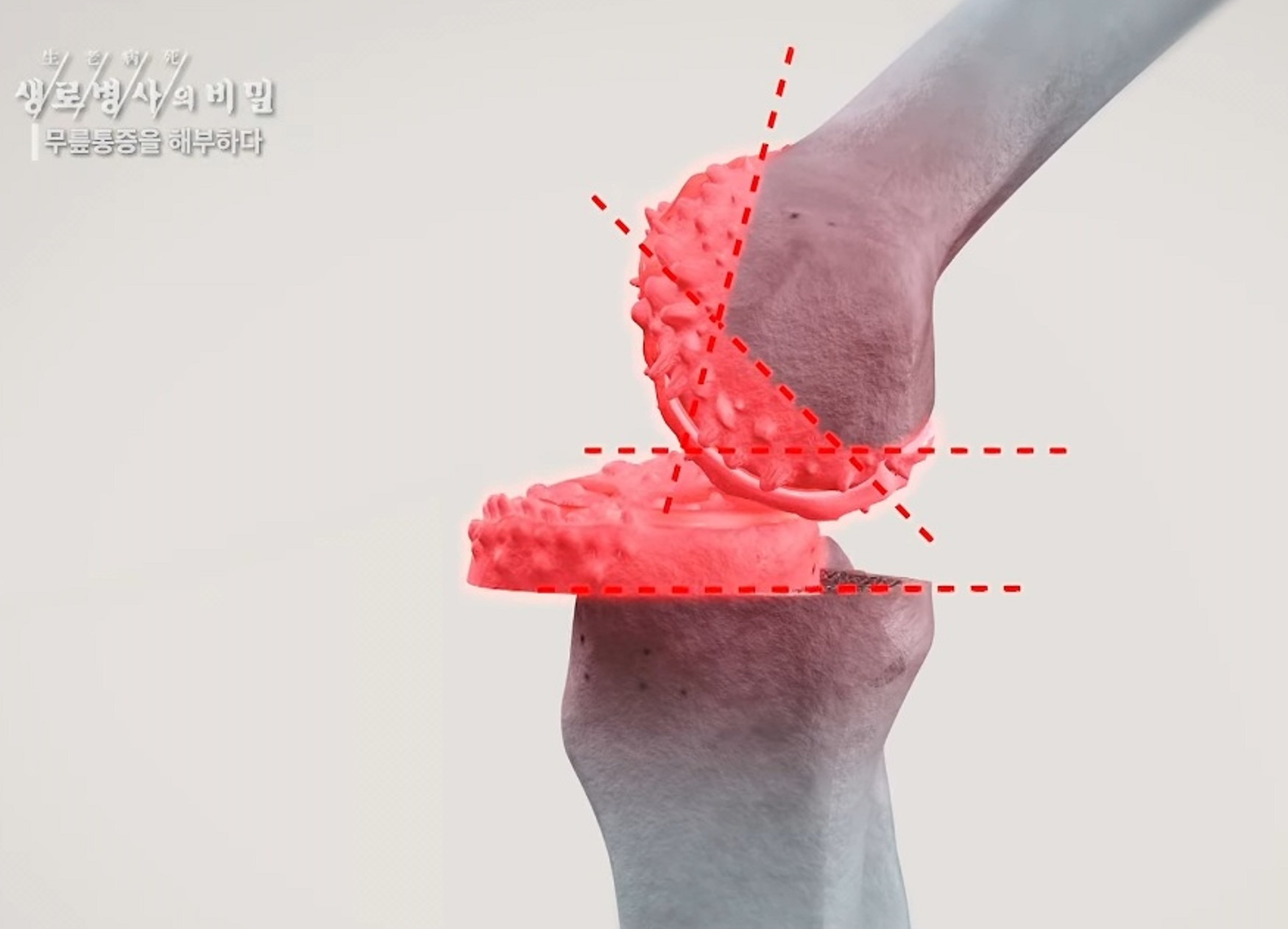 EBS-명의-퇴행성-무릎-관절염