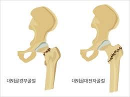 대퇴부 골절