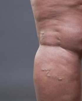 하지 정맥류 증상 27