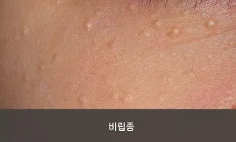 비립종 생기는 이유 비립종 없애는 방법 피부 관리법_17
