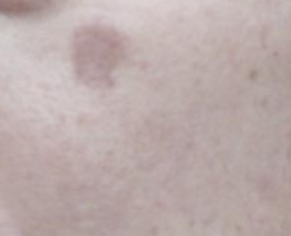 검버섯 없애는 방법