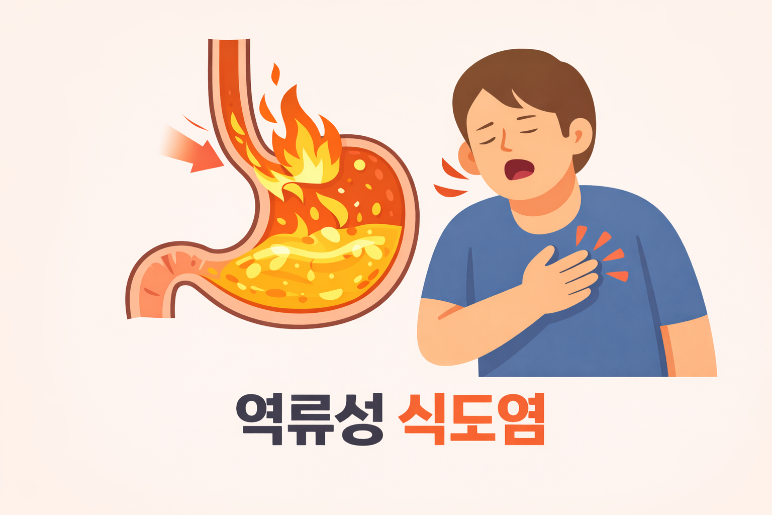 위산이 식도로 역류하는 모습을 표현한 위 일러스트와 가슴 통증을 느끼는 사람 그림으로 역류성 식도염을 직관적으로 설명한 이미지