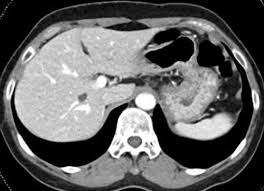 CT(computed tomography)-컴퓨터 단층촬영