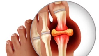 통풍과 스트레스: 스트레스가 통풍에 미치는 영향