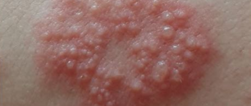 대상포진 초기증상 1