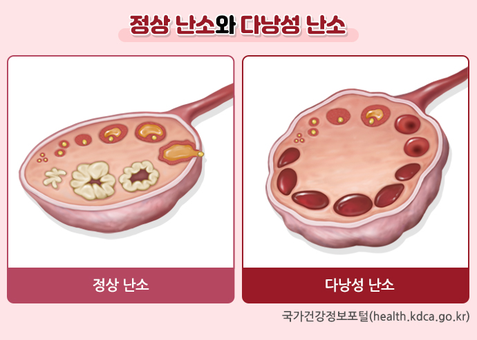 정상 난소와 다낭성 난소