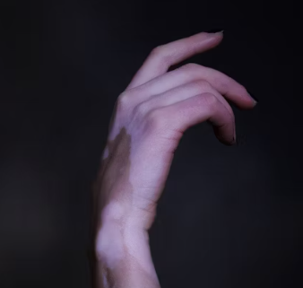 피부 건조증 진단기준 치료방법 합병증 관리