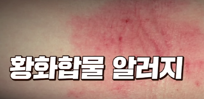 화화합물 알레르기