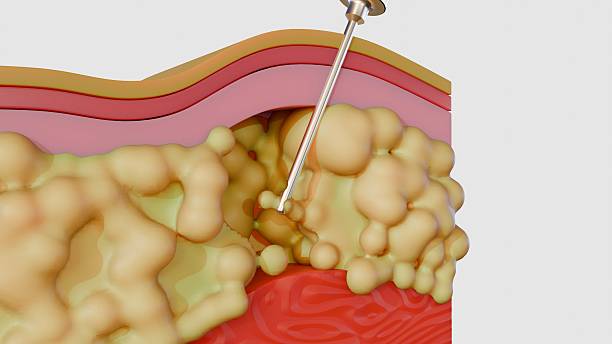 청주 지방이식, 자연스러운 얼굴 라인 복원의 비밀!