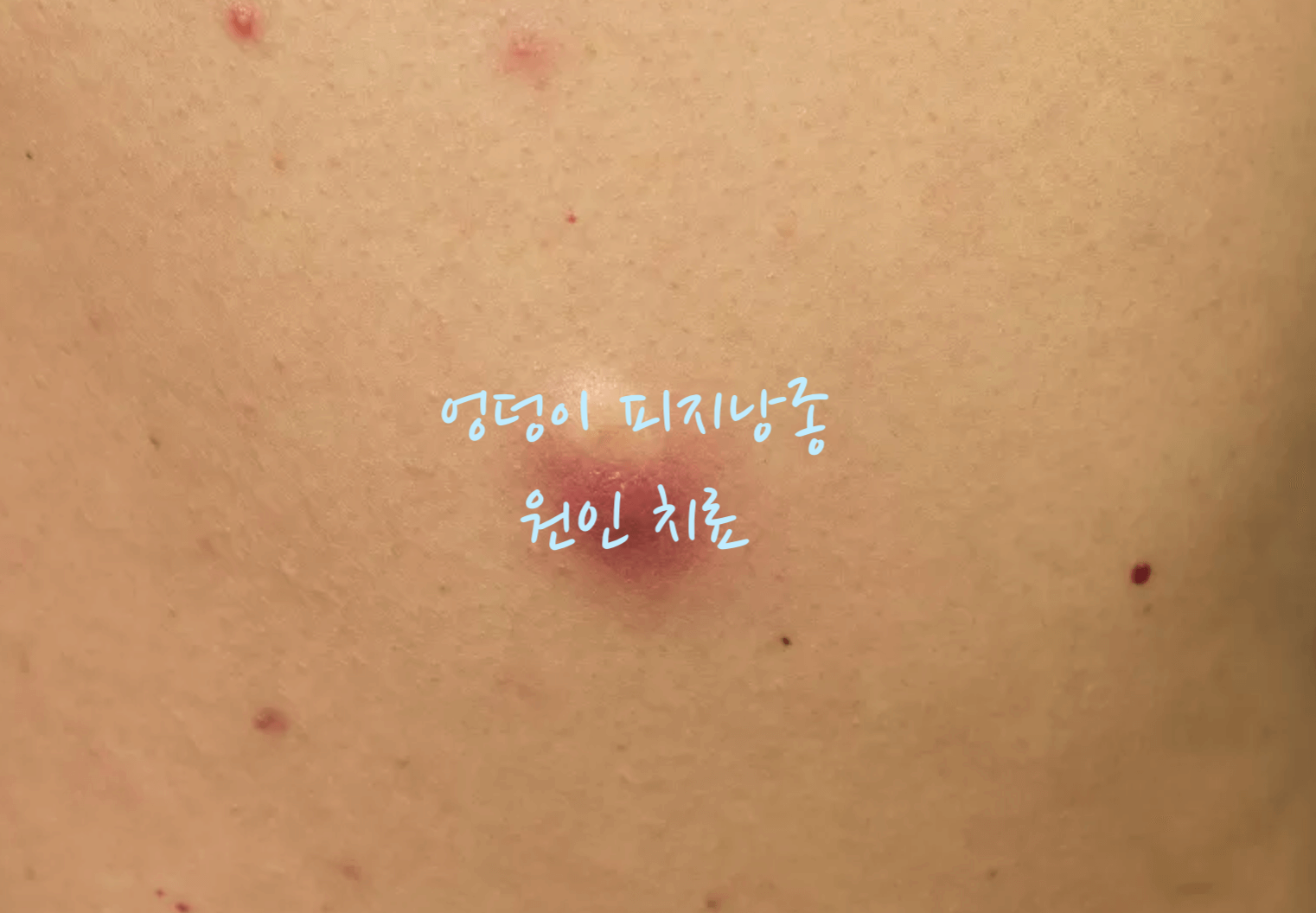 엉덩이 피지낭종 원인