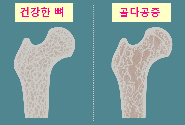 골다공증