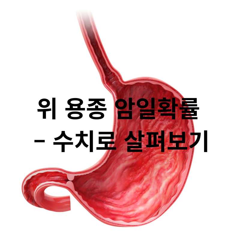 위 용종 암일확률? 걱정되는 분들을 위한 정확한 정보