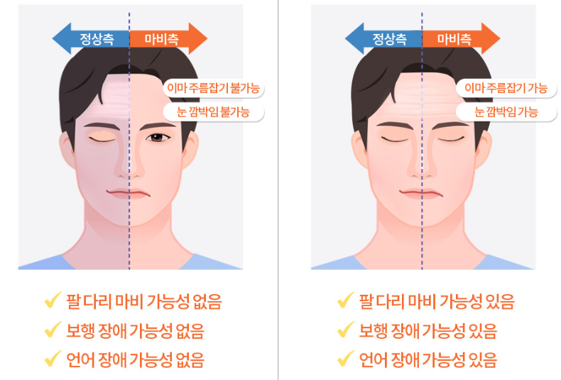 구안와사 초기증상 1