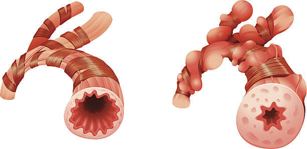 호흡이 힘든 이유, 기관지 협착증 치료 과정 완벽 정리!