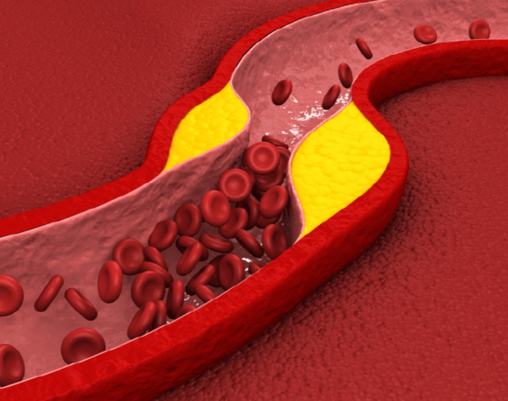 중성지방 정상수치