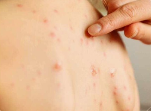 홍역-전신-홍반성-발진