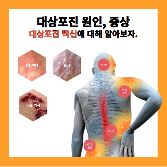 대상포진 원인, 증상