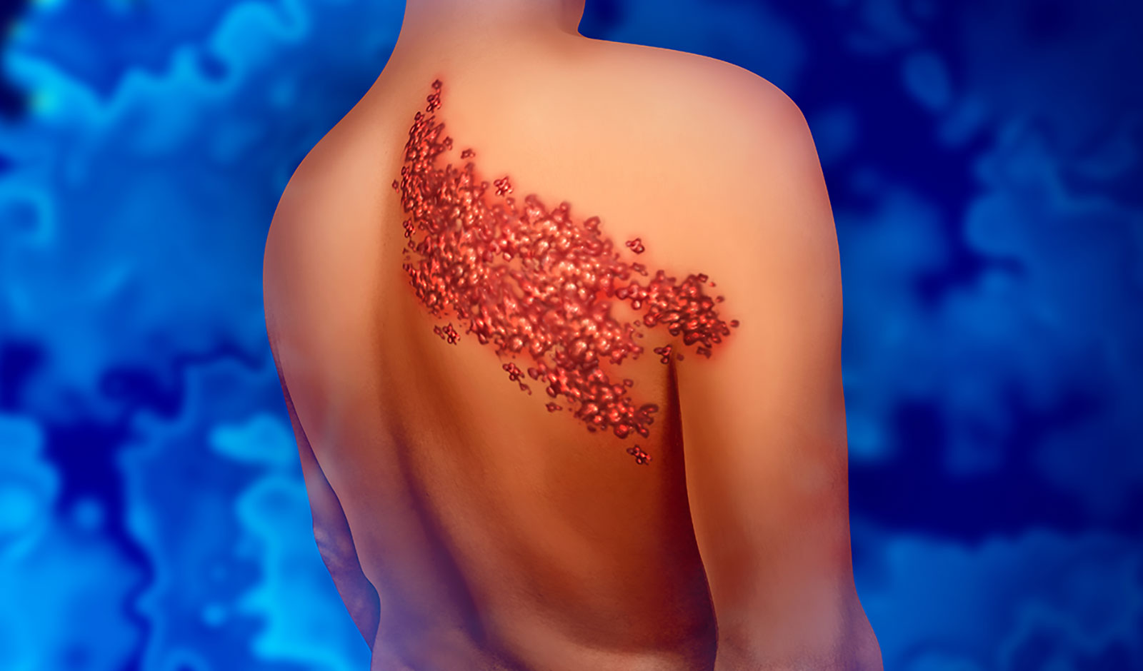 오른쪽 등에 수포가 발생한 대상포진 환자 이미지