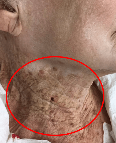 40년 간 선크림을 얼굴에만 바르고 목에는 바르지 않은 92세 여성의 상태