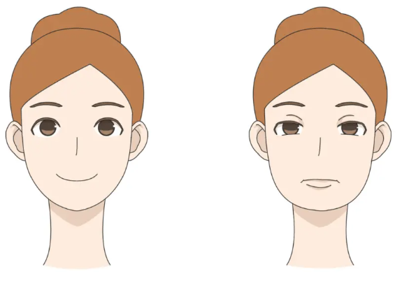 하시모토병에 의한 얼굴 변화의 특징
