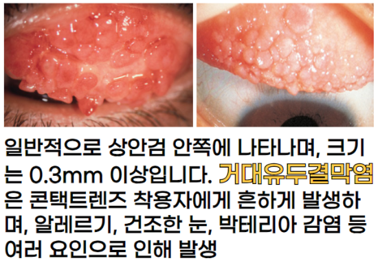 거대유두결막염