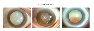백내장