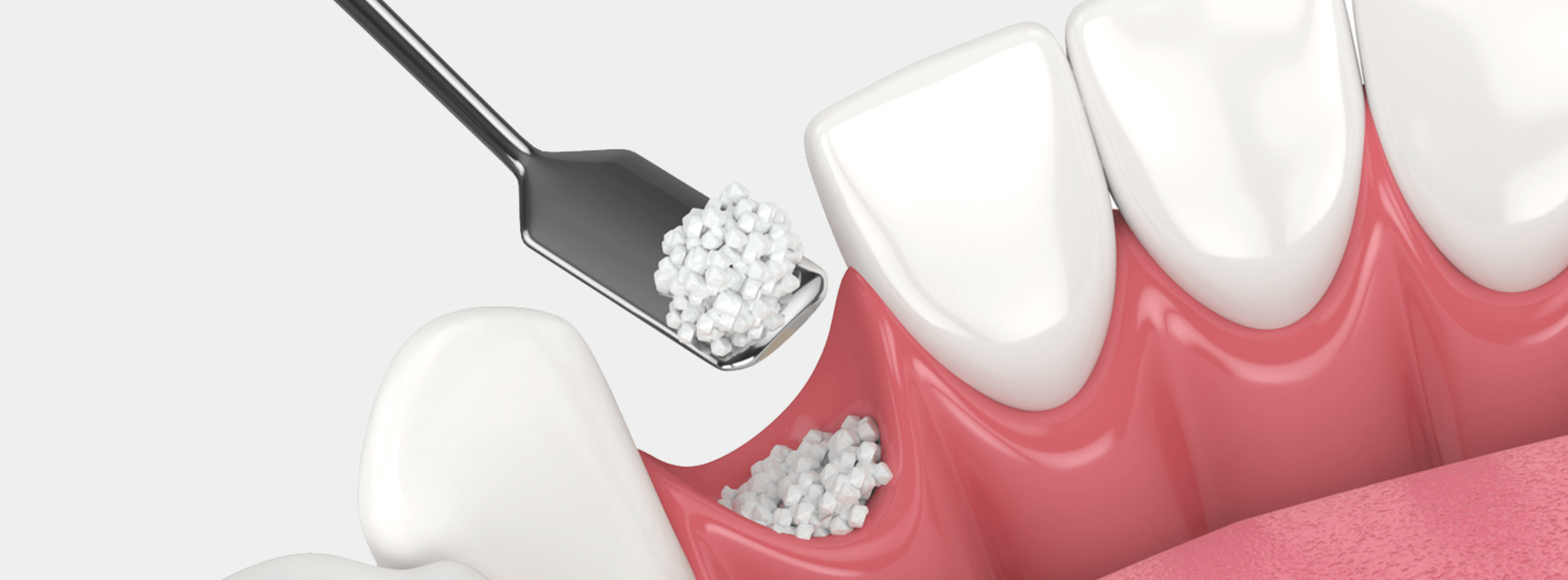 치아 뼈이식 수술